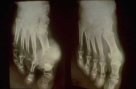 X-ray of gout deposit in the big toe.