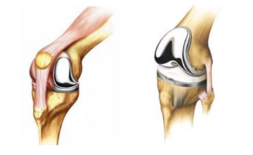 Partial and total knee joint replacement
