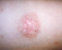 Herald patch in pityriasis rosea