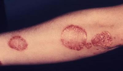 Psoriatic dermatitis