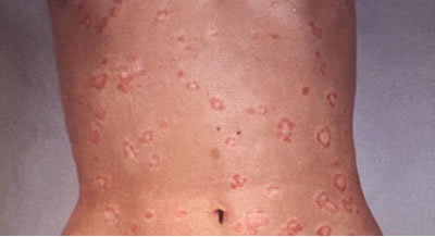 Psoriasis patches in the abdomen